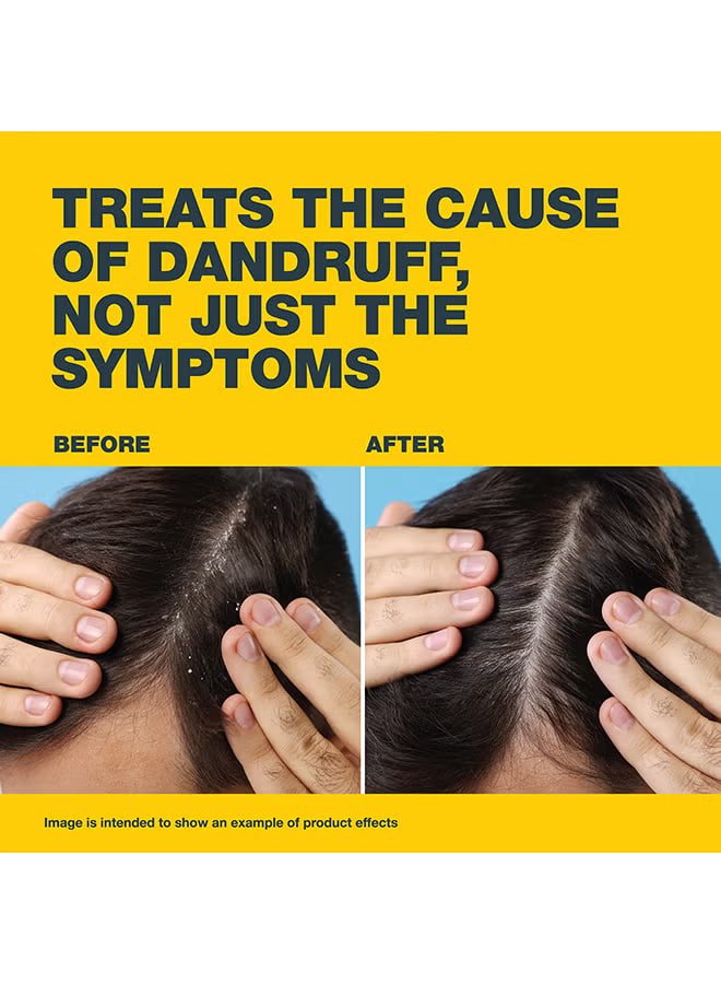 Anti-Dandruff Treatment Shampoo, 100 Ml, Effective Dandruff Treatment, Works From The First Wash, Clinically Proven Ketoconazole Shampoo To Relieve Itchy Scalp 100ml